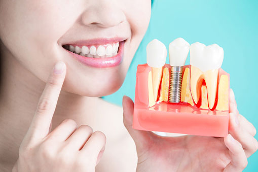 A dental implant is the perfect long-term solution to a missing tooth.